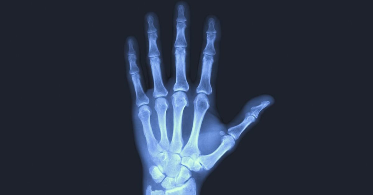 x-ray of hand