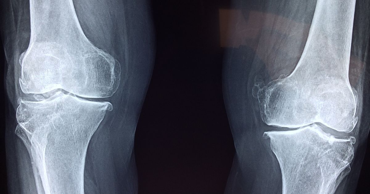 Best Vitamin D3 and K2 Supplements - Bone Health