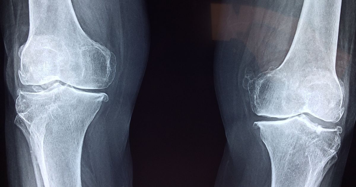 bone xray