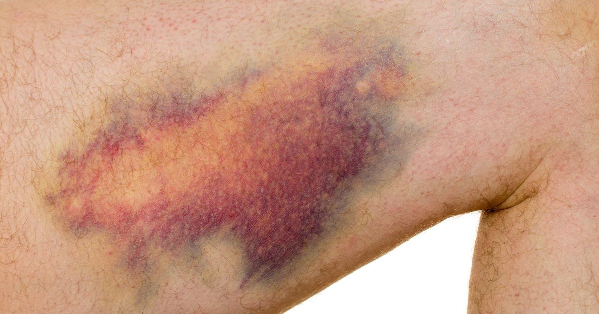 bruised skin